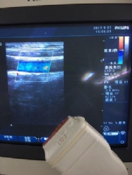 PHILIPS L12-3 ultrasound after repaired performance